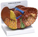 Diseased Human Liver & Gallbladder Anatomy Model with gallstones